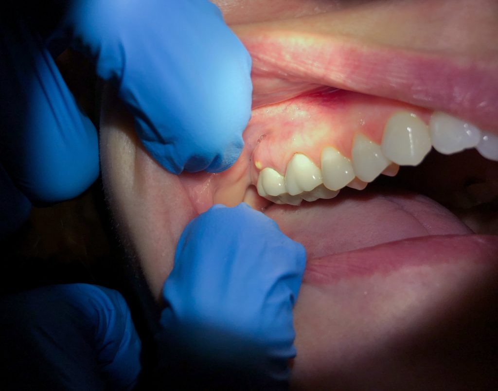 absceso dental