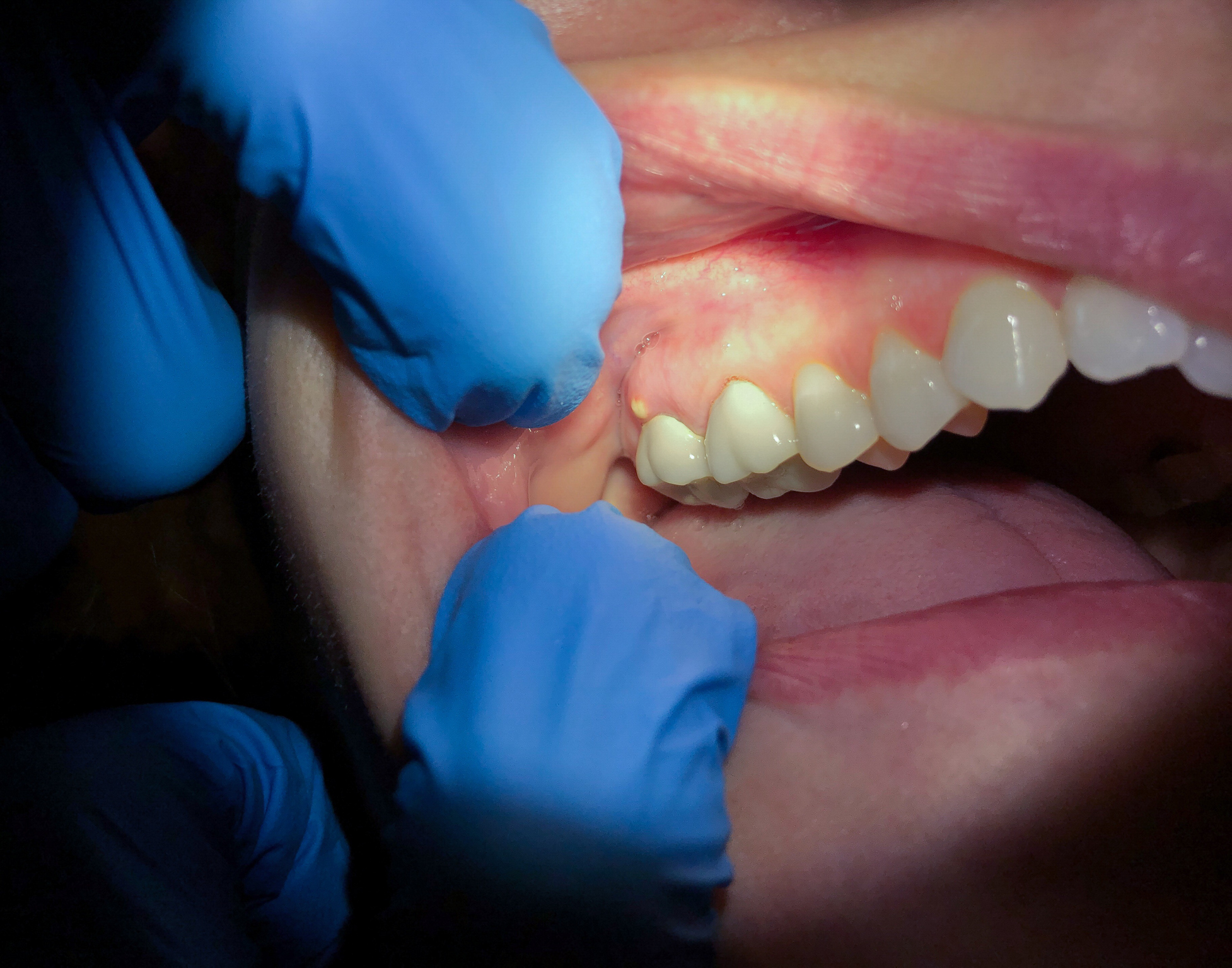 absceso dental