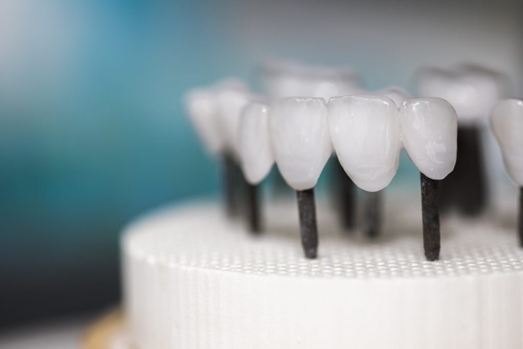implante puente dental