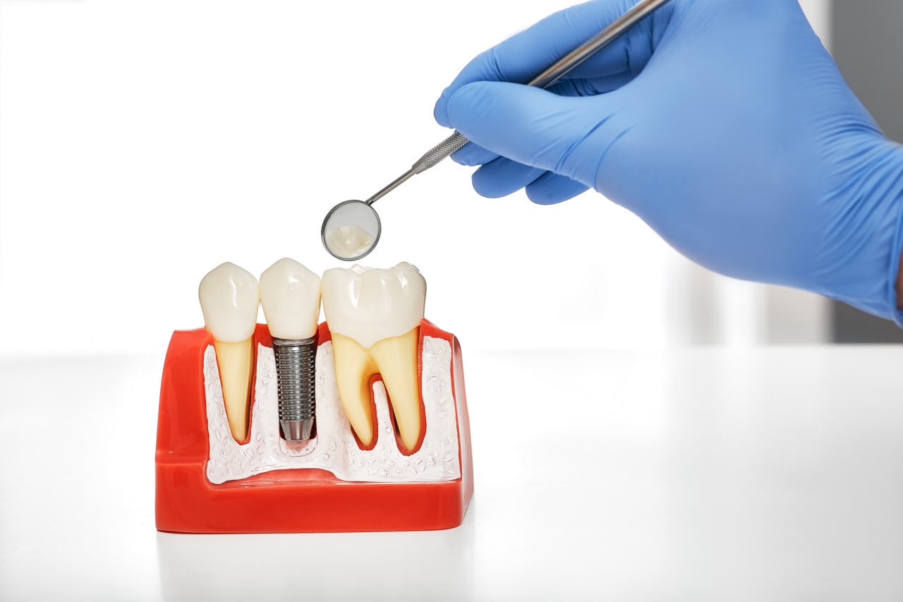 Implantes dentales en Jerez de la Frontera